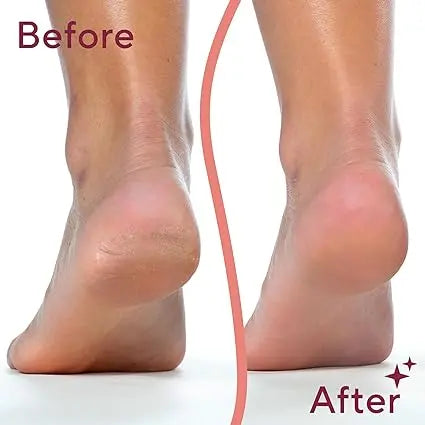 Callus Remover LivSmart