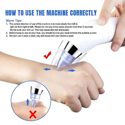 Derma Suction Blackheads Remover LivSmart